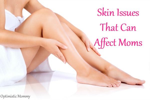 Skin Issues That Can Affect Moms | Optimistic Mommy