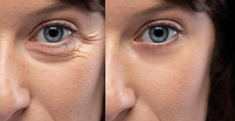 A woman posing before and after removing wrinkles.