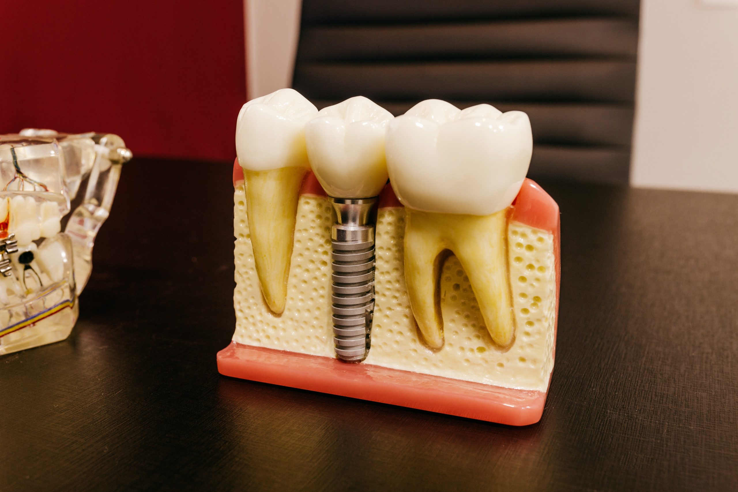 Dental implants are placed in the jaw bones.