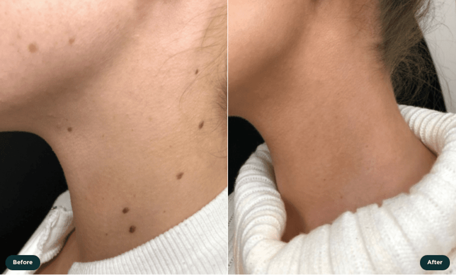 A female with and without moles.