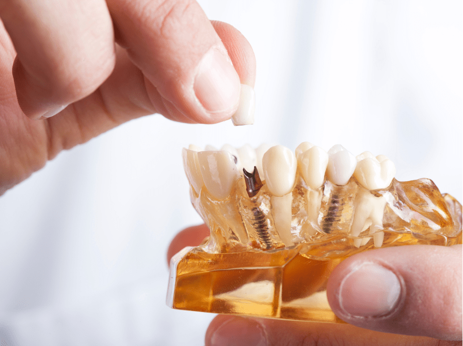 Dental Implant