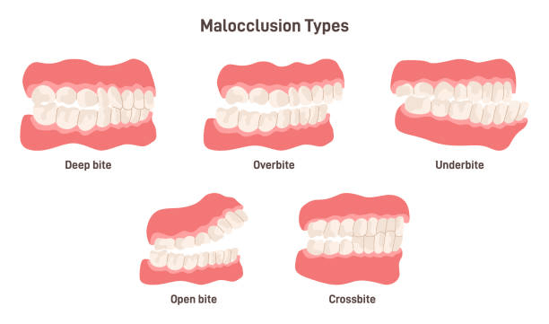 Malocclusion Types: Causes, Symptoms, and Treatment Options