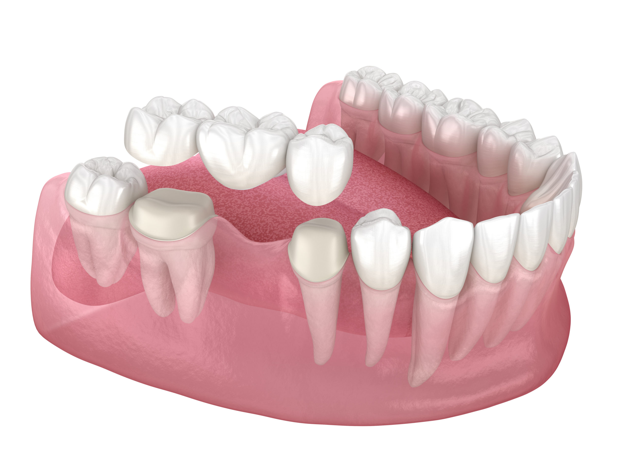 Tooth Implant Vs Bridge: Mom's Dental Care Choices