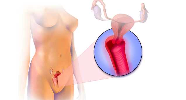 Risk of Bacterial Vaginosis