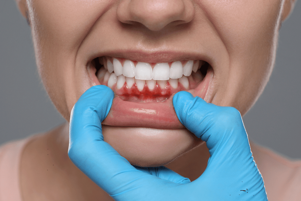 Healthier Gums