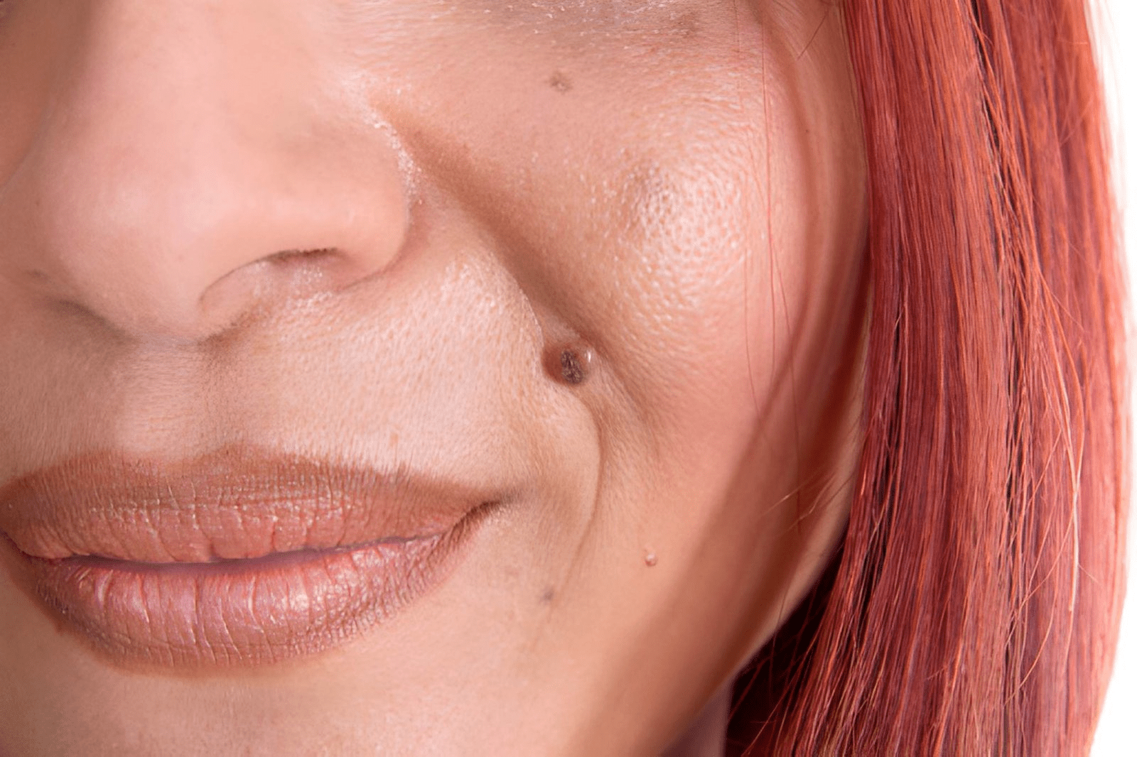 Skin Tags