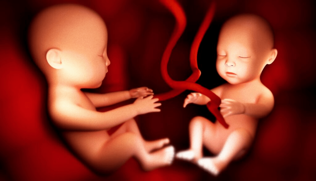 Multiple Pregnancy